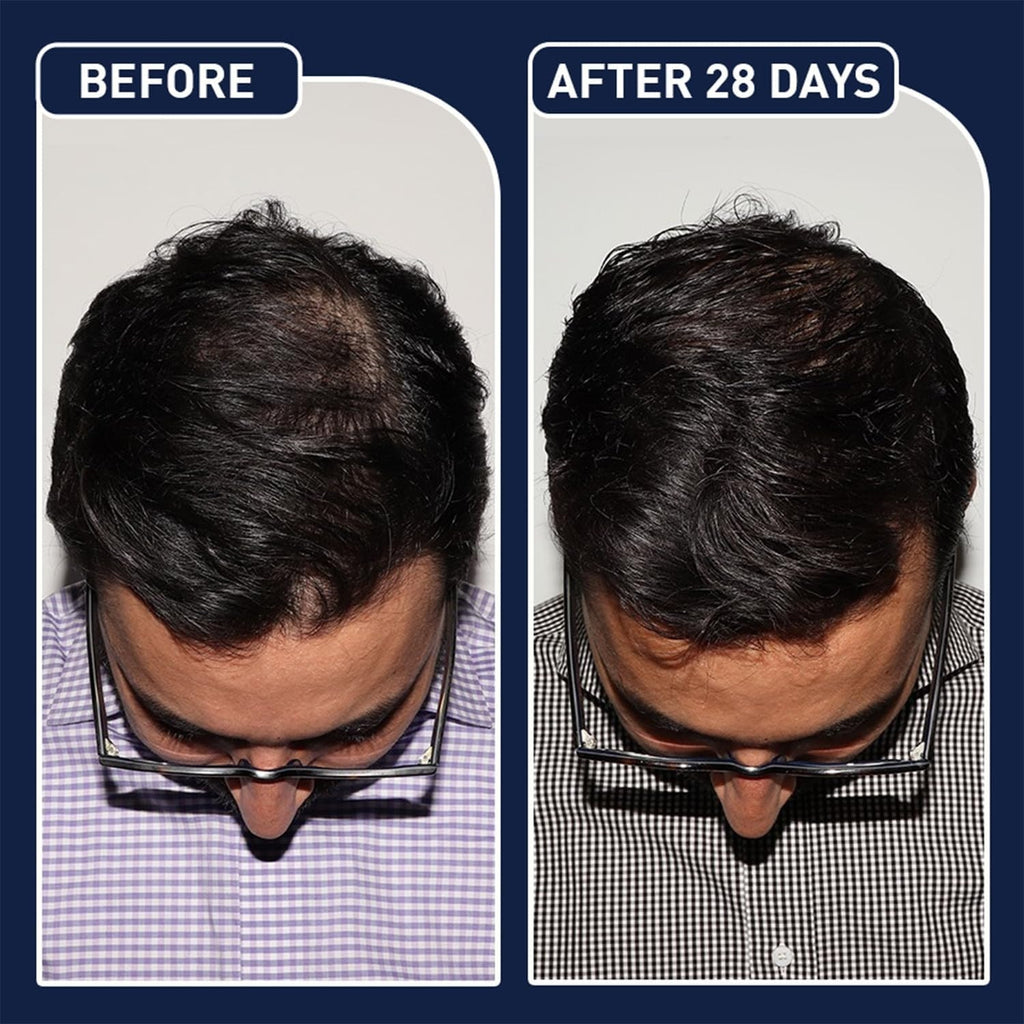 FEGPlus Minoxidil Beard & Hair Growth Serum SKU: WB-OM1014