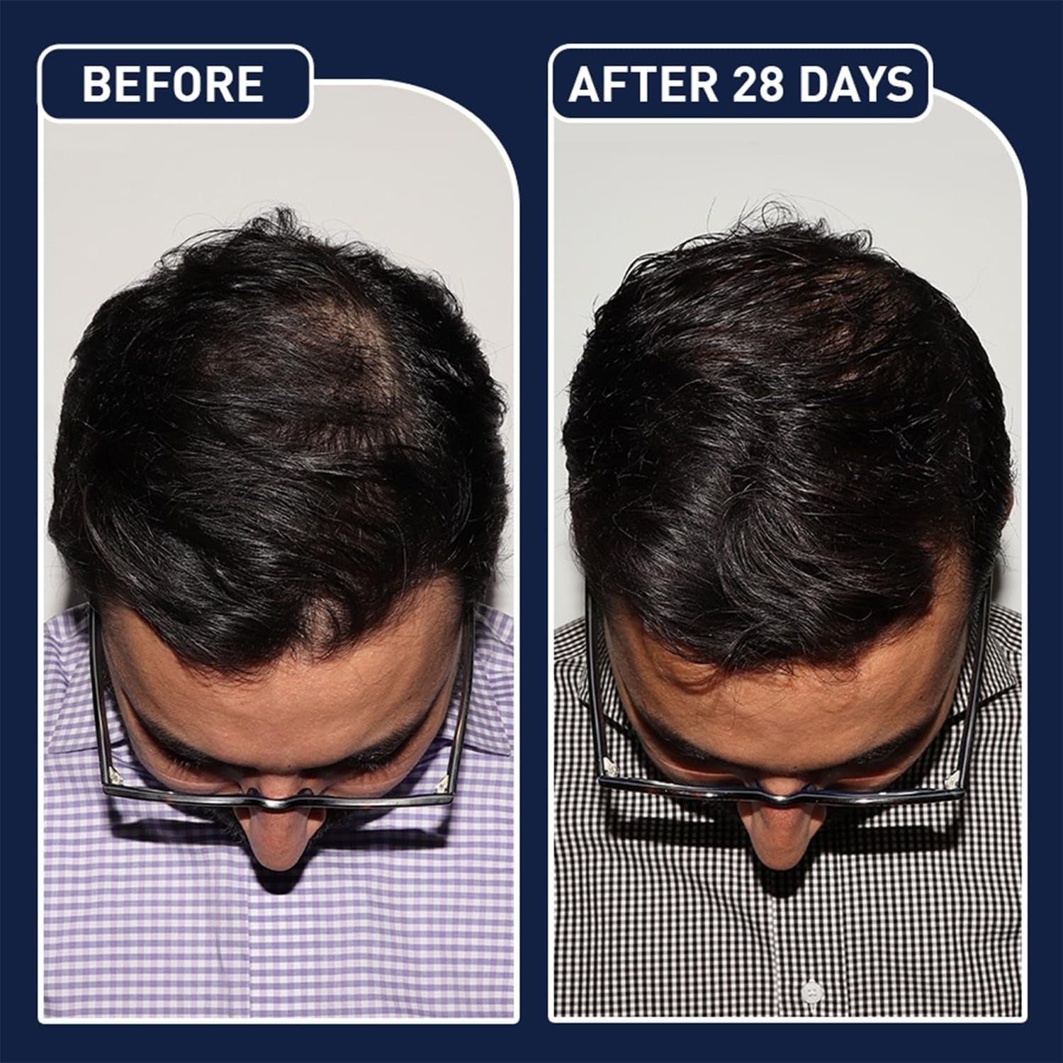 FEGPlus Minoxidil Beard & Hair Growth Serum SKU: WB-OM1014